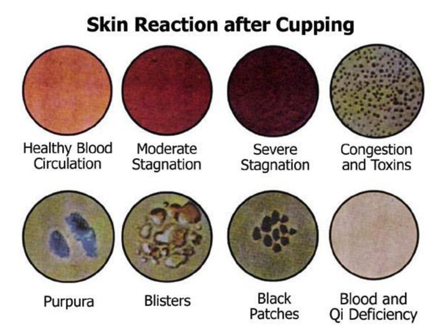 Skin Reaction to cupping
